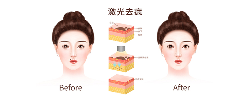 朱砂痣什么意思